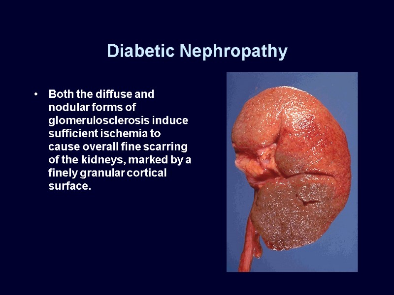 Diabetic Nephropathy Both the diffuse and nodular forms of glomerulosclerosis induce sufficient ischemia to
